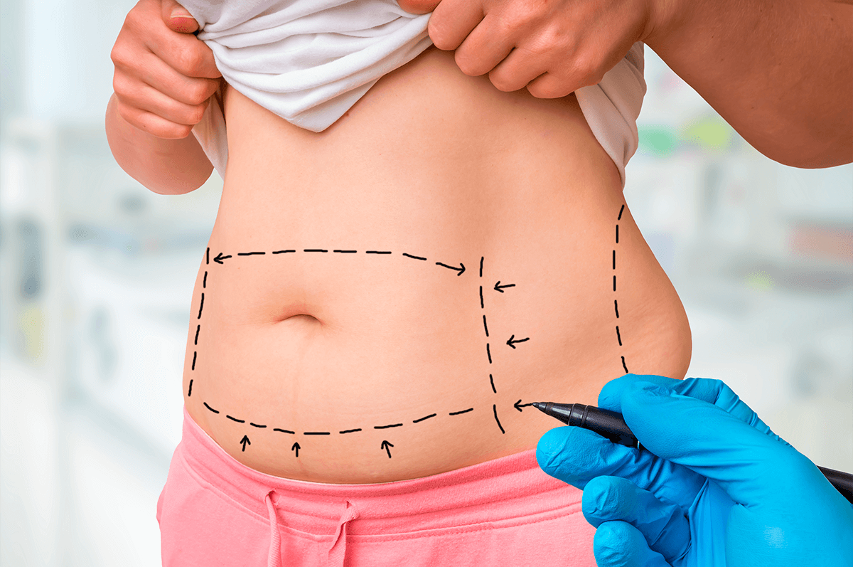  Consórcio de serviço: abdominoplastia