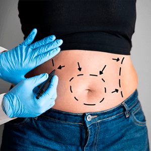 Consórcio de Lipoaspiração