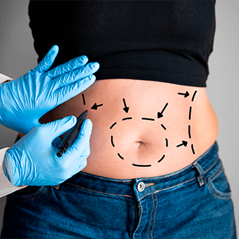 Consórcio de Lipoaspiração
