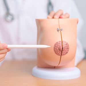Consórcio de Mamoplastia
