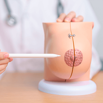 Consórcio de Mamoplastia