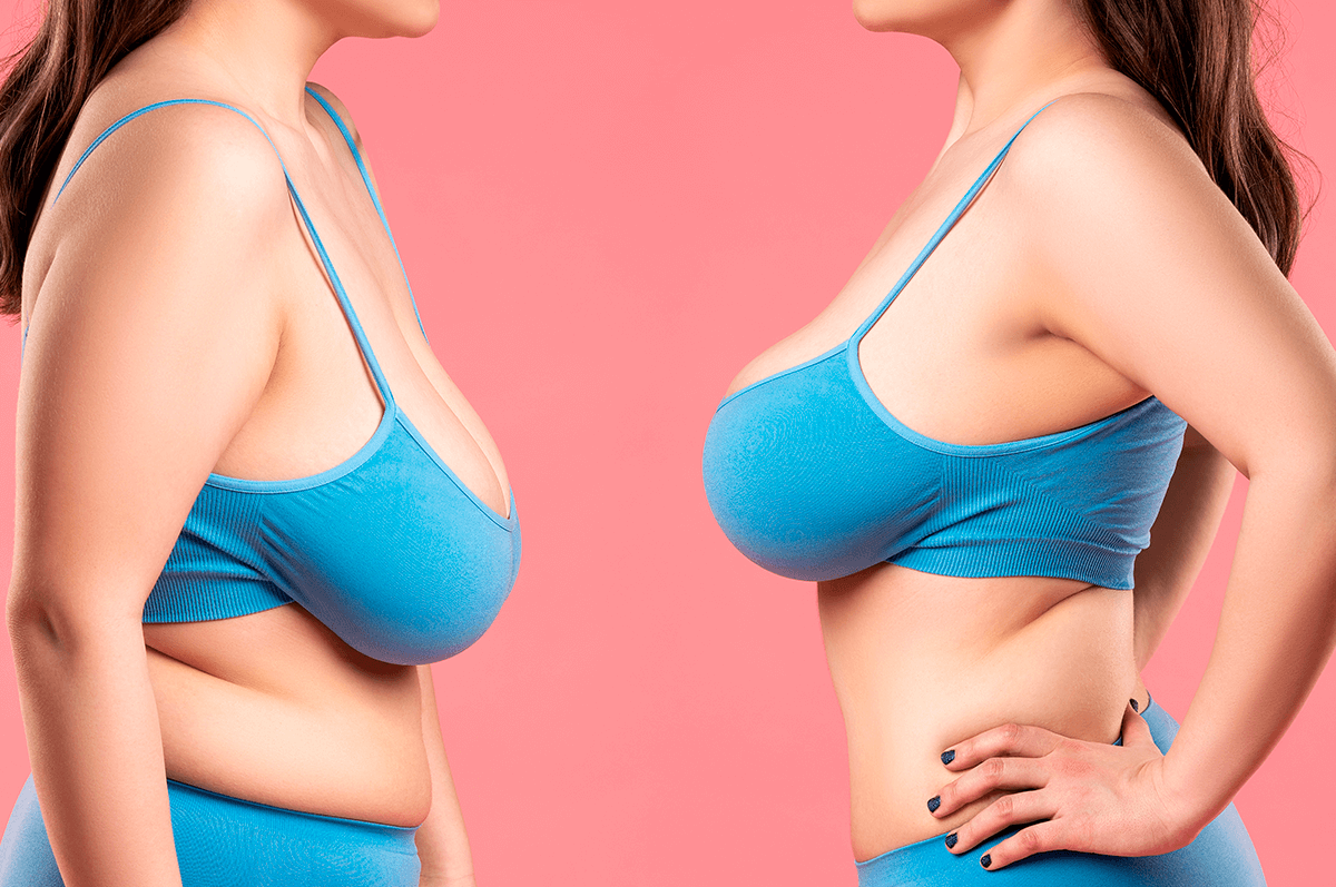  Consórcio de Mamoplastia