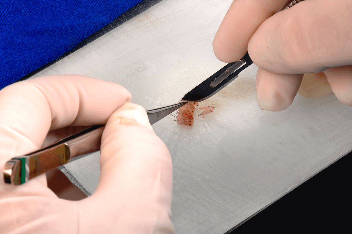  Consórcio de serviço: transplante capilar