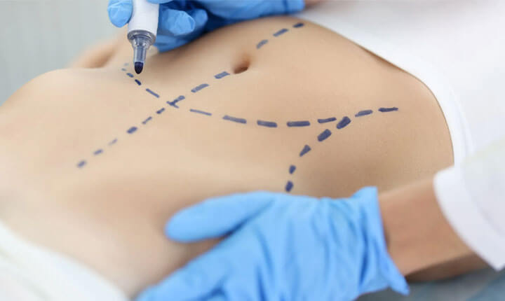 Consórcio de cirurgia plástica: veja como funciona