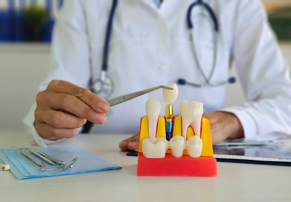  Como funciona implante dentário