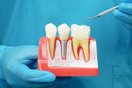 consórcio de implante dentário